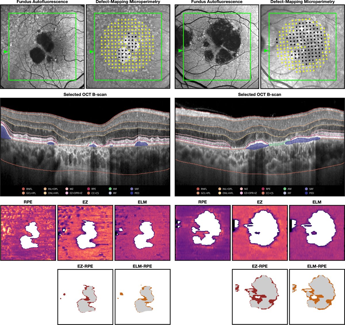 AAOjournal's tweet image. Geographic Atrophy Structure-Function Relationships Based on Loss of OCT Outer Retinal Bands and Fundus Autofluorescence
ow.ly/IHlB50XJHyU 
#ophthalmology