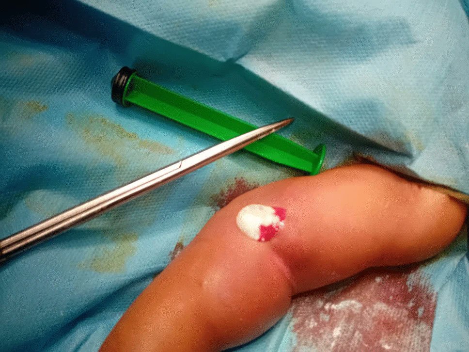 Ped_Neph's tweet image. Lesch–Nyhan syndrome is a rare X-linked recessive disorder. It is characterized by severe neurological manifestations &amp;amp; self-injurious behavior. Kidney involvement is an underrecognized but important aspect. Read these Clinical Insights for more.
link.springer.com/article/10.100…