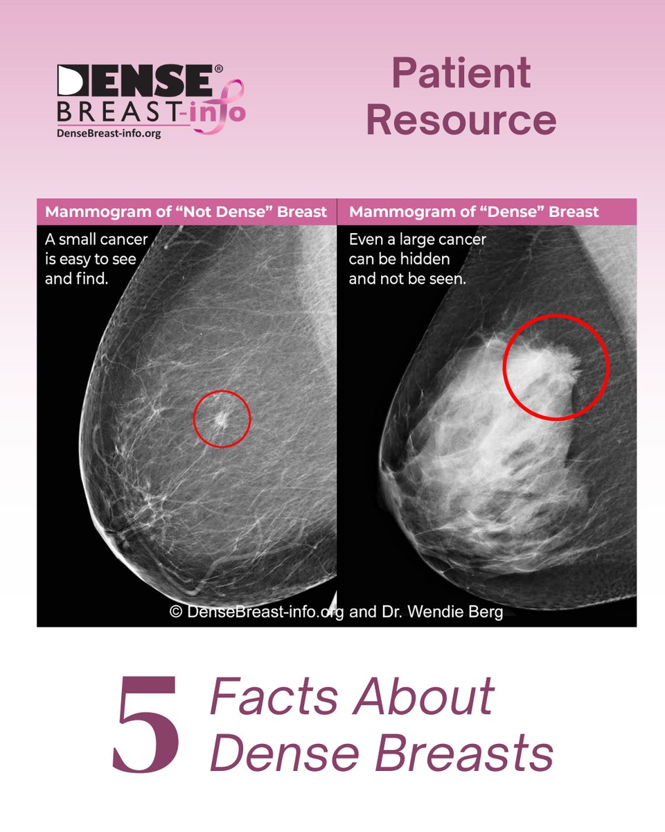 Nearly half of women have dense breasts—and it matters. Dense tissue can hide cancer on mammograms. Learn what this means for your screening. Read more 🔗 densebreast-info.org/for-patients/5…