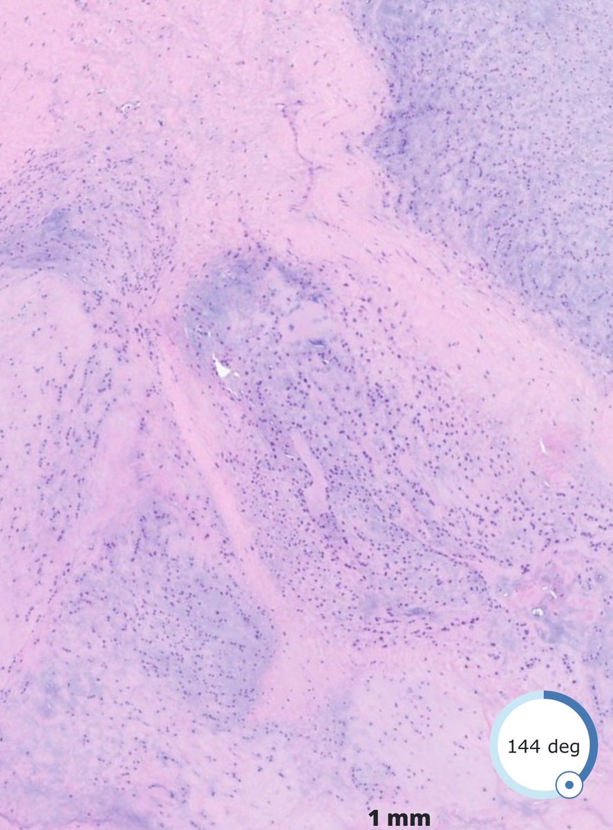 DrBuiPathology's tweet image. #DrBuiBSTCaseCollection Ossifying fibromyxoid tumors (OFMTs)🌼Most common recurrent gene fusion is PHF1🌻PHF1::TFE3 fusions are linked to malignancy.🔬⁦High nuclear grade, high cellularity and &amp;gt; 2 mitoses/50 HPFs = malignant. #PathTwitter ⁦#PathX ⁦@USFpathology⁩ ⁦