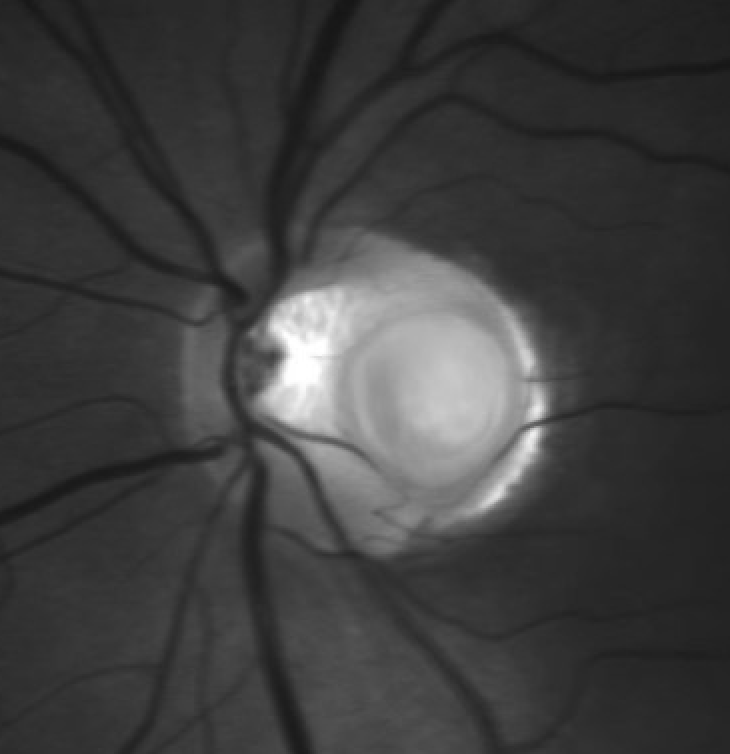 RetinaSociety's tweet photo. Optic disc pit with subretinal fluid. https://t.co/IiPckFu8ti