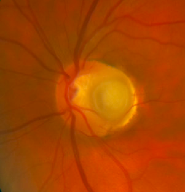RetinaSociety's tweet photo. Optic disc pit with subretinal fluid. https://t.co/IiPckFu8ti