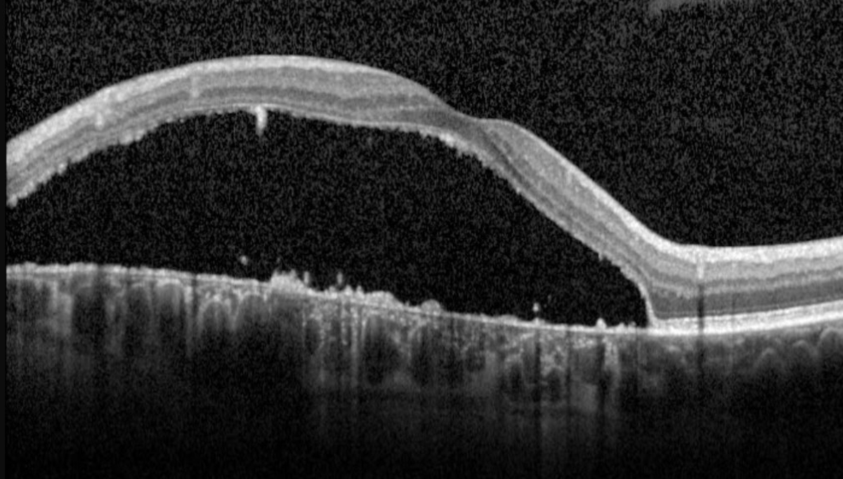 RetinaSociety's tweet photo. Optic disc pit with subretinal fluid. https://t.co/IiPckFu8ti