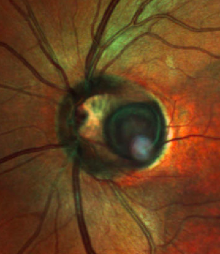 RetinaSociety's tweet photo. Optic disc pit with subretinal fluid. https://t.co/IiPckFu8ti