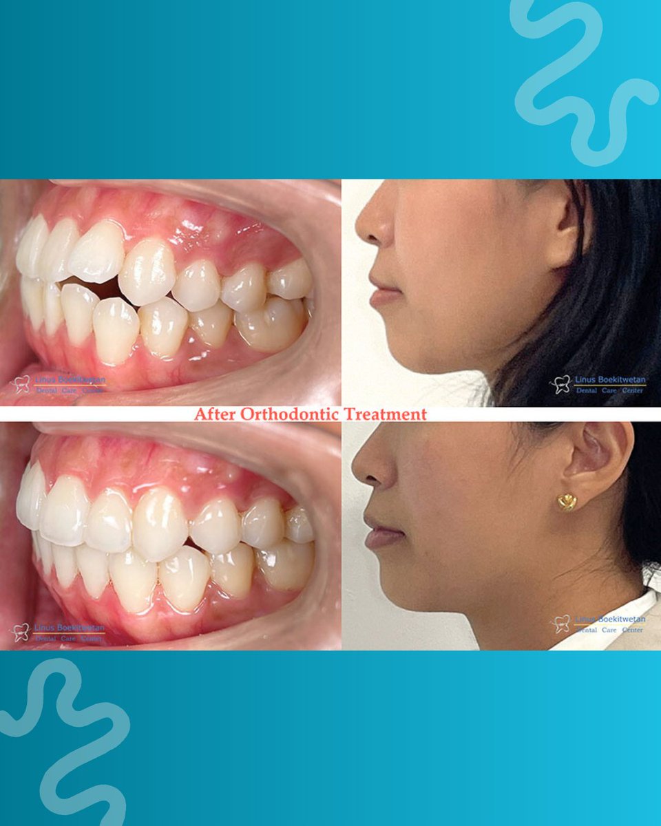 DrgLinus's tweet photo. New smile, new chapter, new me 🫶🏻

#drglinus #behelgigi #dentist #braces #gigirapih https://t.co/tENRJeALRH