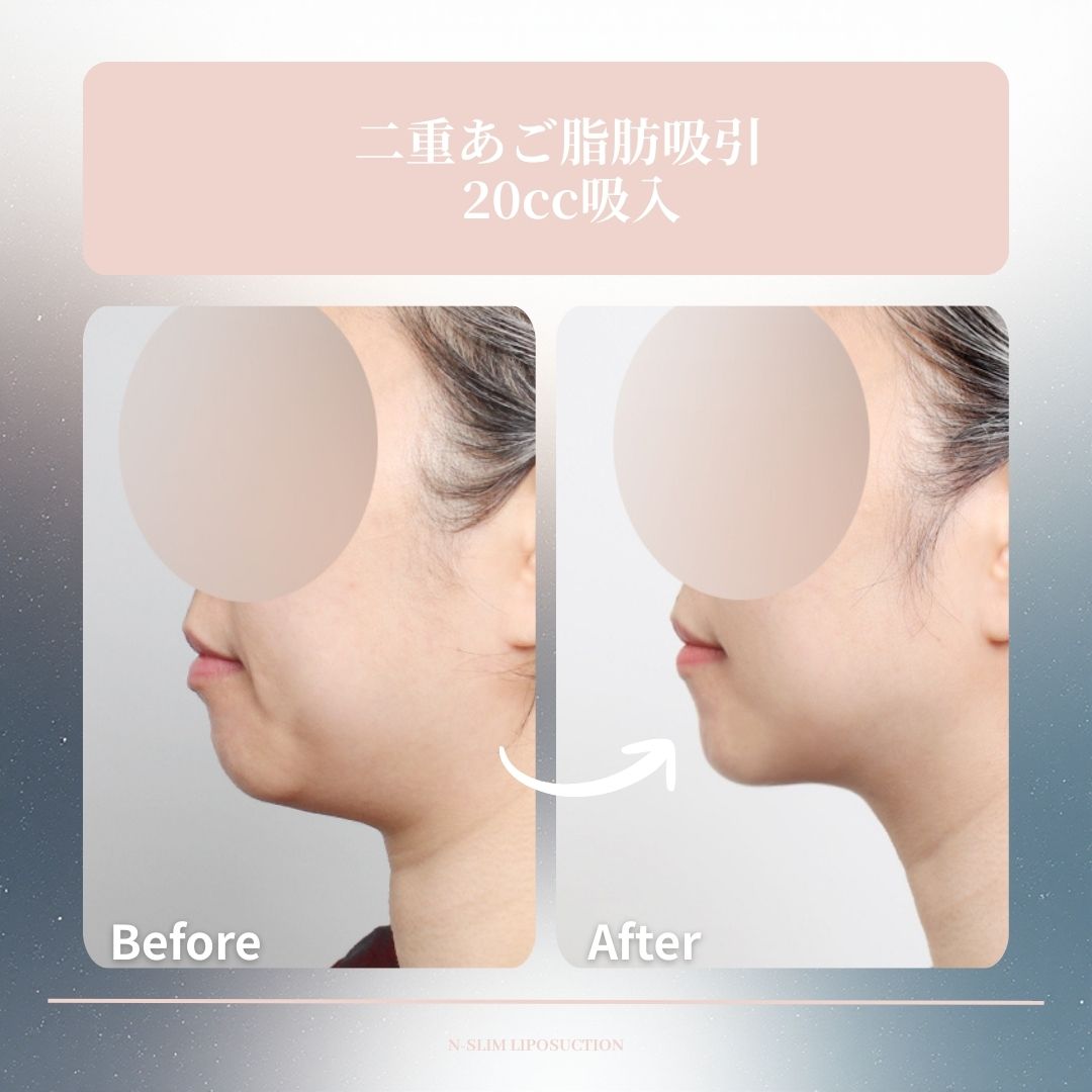 Nスリムの顔脂肪吸引の施術ポイント🤗
 ⏱️手術時間:30分
 💉麻酔:睡眠麻酔　
 🏥通院治療:なし  
 🏡日常生活:翌日から可能   

📸二重あご脂肪吸引(20cc）

☘️お問い合わせ
(日本語対応可能)
📲82-10-6771-4500
LINE ID : @nslim

💓日本語通訳が常駐しています🥰
診療時間内に対応します。