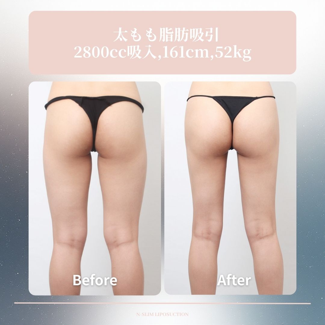 前・後どちらから見ても変わった太ももライン✨
Nスリムの360度太もも脂肪吸引💫

📸2800㏄吸入,161cm,52kg

☘️お問い合わせ
(日本語対応可能)
📲82-10-6771-4500
LINE ID : @nslim

💓日本語通訳が常駐しています🥰
診療時間内に対応します。

☘️診療時間案内
火曜日~金曜日 10時~19時
土曜日