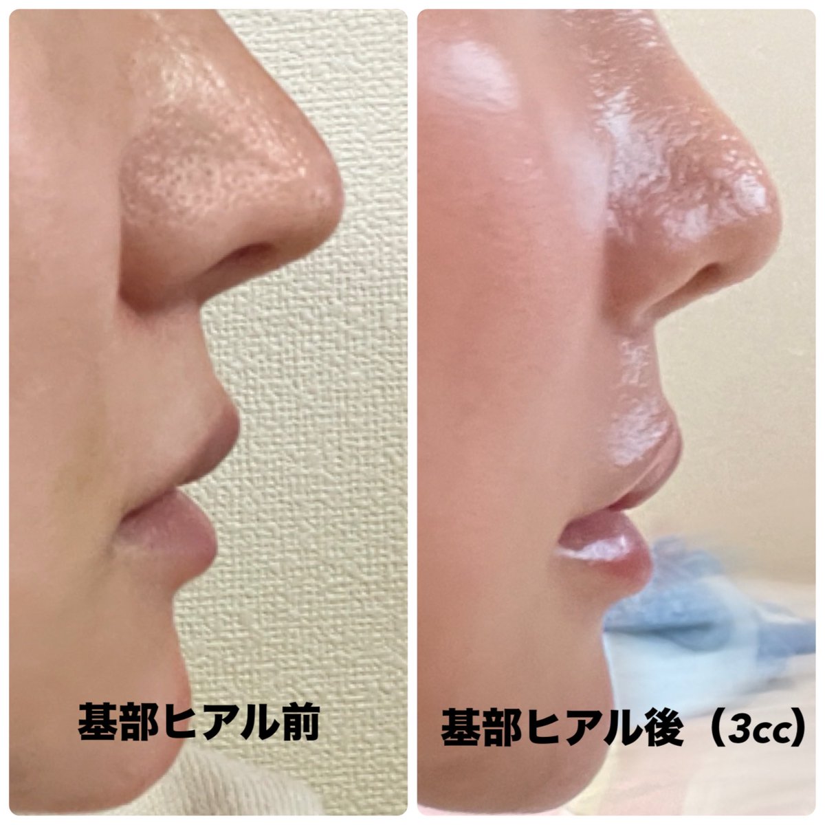 貴族ヒアルは回数を分けて左右計3cc

凹みが埋まらず量だと思って追加したけど、
人中が伸びる感じしかしなかった😇
壊死リスクを考えるのもストレス

結果▼
・凹みは完全に平らにならない
・人中が間延びして見える
・小鼻が潰れて鼻先が短く見える

量の問題じゃなく骨格と凹み位置が合わなかった！ https://t.co/NLYNXLPUTU