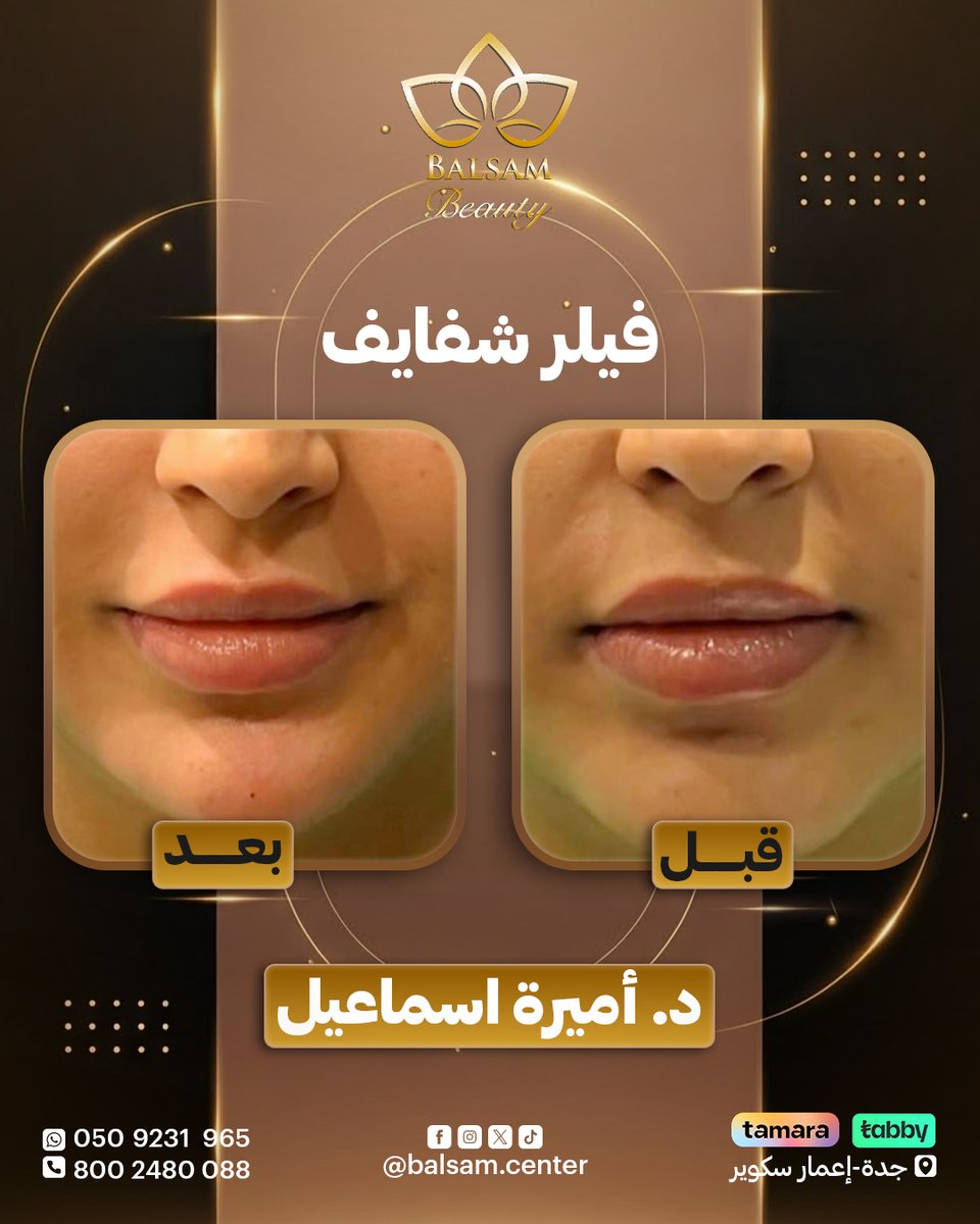 تحديد الشفاه وجلها ممتلئة بتحديد طبيعي بلمسة د.أميرة اسماعيل
احجزي موعدك اليوم !

واتساب 0509231965
اتصال 800248008
📍جدة - إعمار سكوير