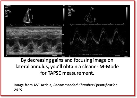 Ahmedata7777's tweet photo. TAPSE Reference Values ASE 2025

The 2025 ASE Right Heart Guidelines maintain the traditional TAPSE cutoff of >1.7 cm for normal function but now introduce graded severity ranges (mild, moderate, severe) for more precise reporting of abnormal findings. 

The guidelines reaffirm that a TAPSE 1.7 cm or below remains highly suggestive of RV systolic dysfunction.

#echo #medical #cardiology #hearthealth #cardio