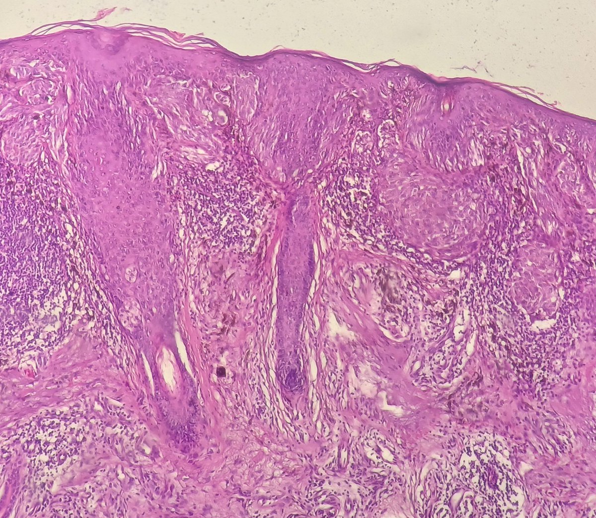 SbrSarra's tweet image. 64 years old F . Pigmented tumor of the face.  #pathology #dermpath #patholo