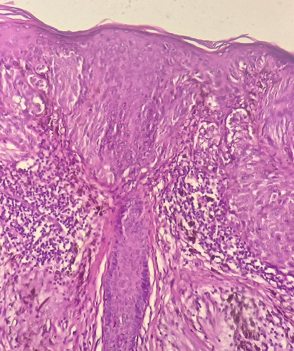 SbrSarra's tweet image. 64 years old F . Pigmented tumor of the face.  #pathology #dermpath #patholo