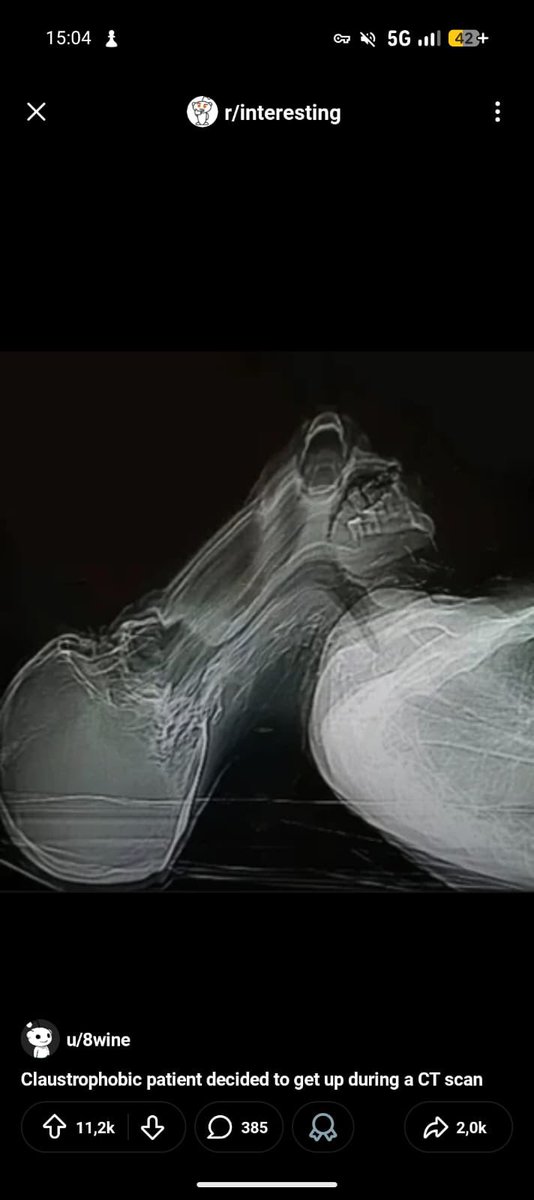 Un malade claustrophobe se lève pendant une Irm 😅