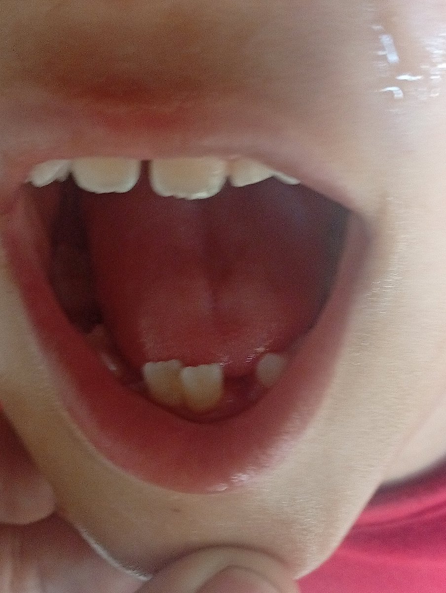 hmd_mhmd9832's tweet image. Unfortunately, I will die 😭

My little brother is losing weight rapidly due to severe dental pain. All his teeth are badly damaged, and we cannot afford his treatment. We are afraid of losing him.

If you're browsing, please leave a dot. It's just a d
chuffed.org/project/127878