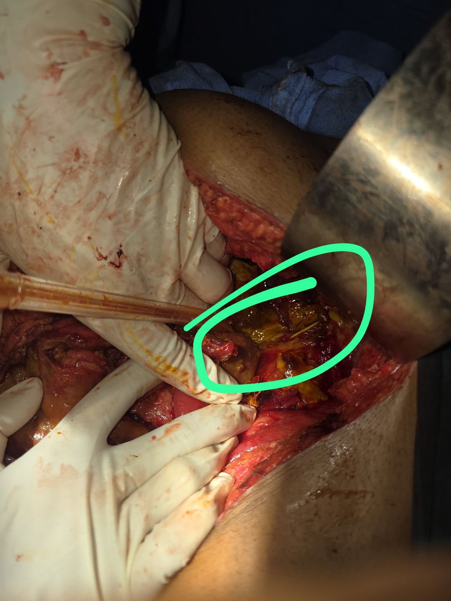 Looks like ERCP stenting didn’t go as planned, leads to necrosis of CBD.
#MedTwitter