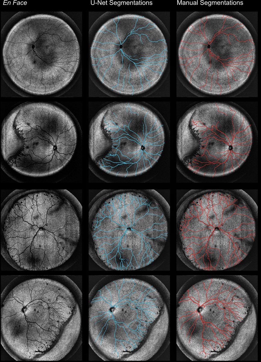 AAOjournal's tweet image. Automated feature segmentation of ultra-widefield optical coherence tomography images
ow.ly/zWIY50XJHKY 
#ophthalmology