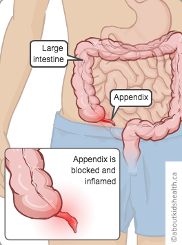 AboutKidsHealth's tweet image. Appendicitis happens when the appendix becomes infected. It may cause pain, nausea and loss of appetite, and fever may develop. Learn more about signs and symptoms and when to see a health-care provider: ow.ly/glQk50UCTre #Appendicitis #Appendix #HealthCare