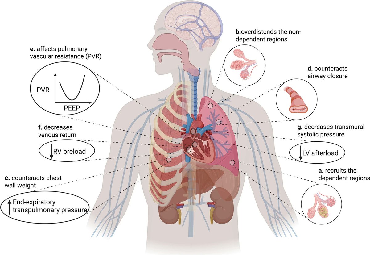 Intrathoracic effects of PEEP: beyond oxygenation

CCR Journal Watch
criticalcarereviews.com/latest-evidenc…