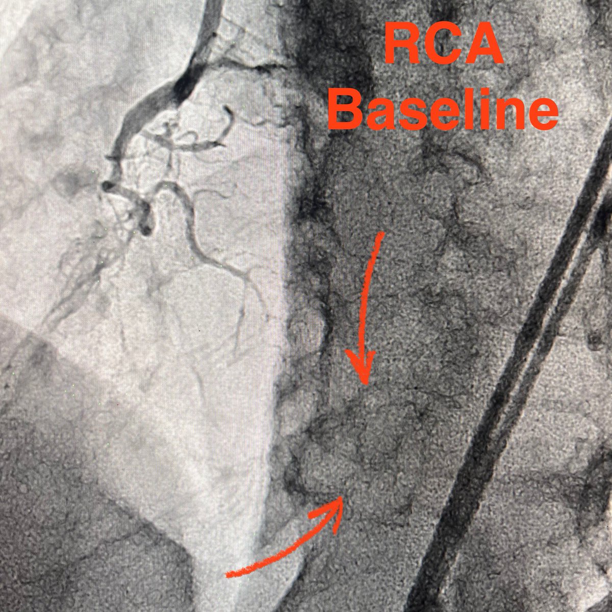 realarainmd's tweet photo. New Year, New Resolution!

Here is my resolution for 2026! Implant less metal! 🤞🏼

Here is a case from this week - failed RCA #CTOPCI at OSH. We were also unable to cross despite multiple #HDR, #TDADR, retro attempts. 

Settled for IVI guided, CBA facilitated STAR! Will f/u with PET in a few weeks.