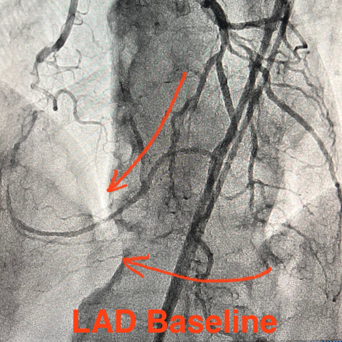 realarainmd's tweet photo. New Year, New Resolution!

Here is my resolution for 2026! Implant less metal! 🤞🏼

Here is a case from this week - failed RCA #CTOPCI at OSH. We were also unable to cross despite multiple #HDR, #TDADR, retro attempts. 

Settled for IVI guided, CBA facilitated STAR! Will f/u with PET in a few weeks.