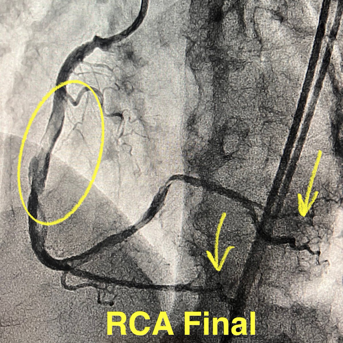 realarainmd's tweet photo. New Year, New Resolution!

Here is my resolution for 2026! Implant less metal! 🤞🏼

Here is a case from this week - failed RCA #CTOPCI at OSH. We were also unable to cross despite multiple #HDR, #TDADR, retro attempts. 

Settled for IVI guided, CBA facilitated STAR! Will f/u with PET in a few weeks.