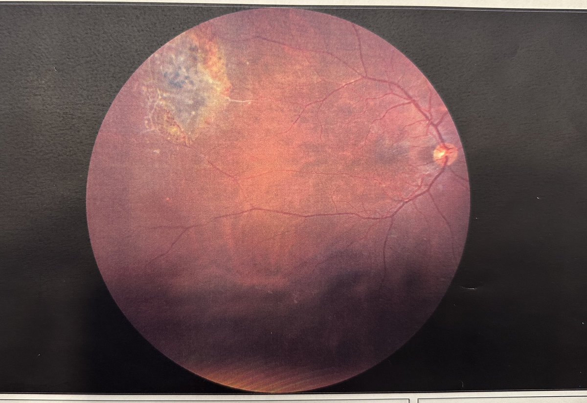 Gün geçtikçe yeni bulgular ; göz iltihabı ve damar tıkanıklığı

İlgili makamların yorumları ;

“Bu vaka ileri yaşta görülebilir fakat bu yaşta olması normal değildir. Biz de bu görüntüyü istisna olarak kenarda tutacağız. Müdaheleye geç kalınmamalı”

Önerilen işlem :  Göz anjiyosu