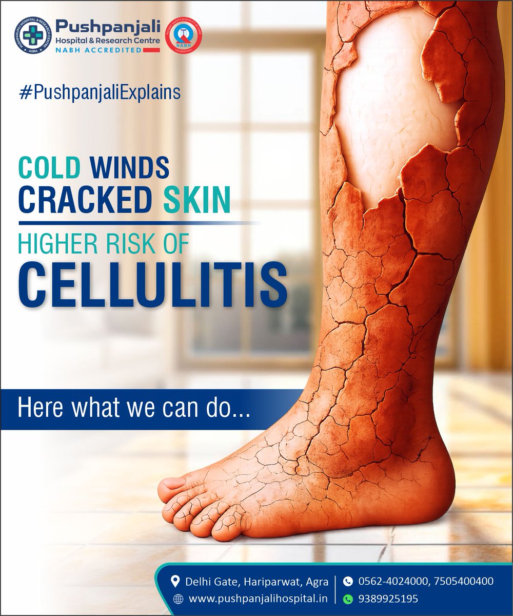 PHRCAGRA's tweet photo. Cracked skin in winter may signal a higher risk of Cellulitis

At @PHRCAGRA, our specialists from the Departments of Internal Medicine and Dermatology emphasize early evaluation, proper skin care and prompt treatment. 
Call Now - 7505 400 400 | 9389 925 195
#follow #like #share https://t.co/SwMWQhQTE6