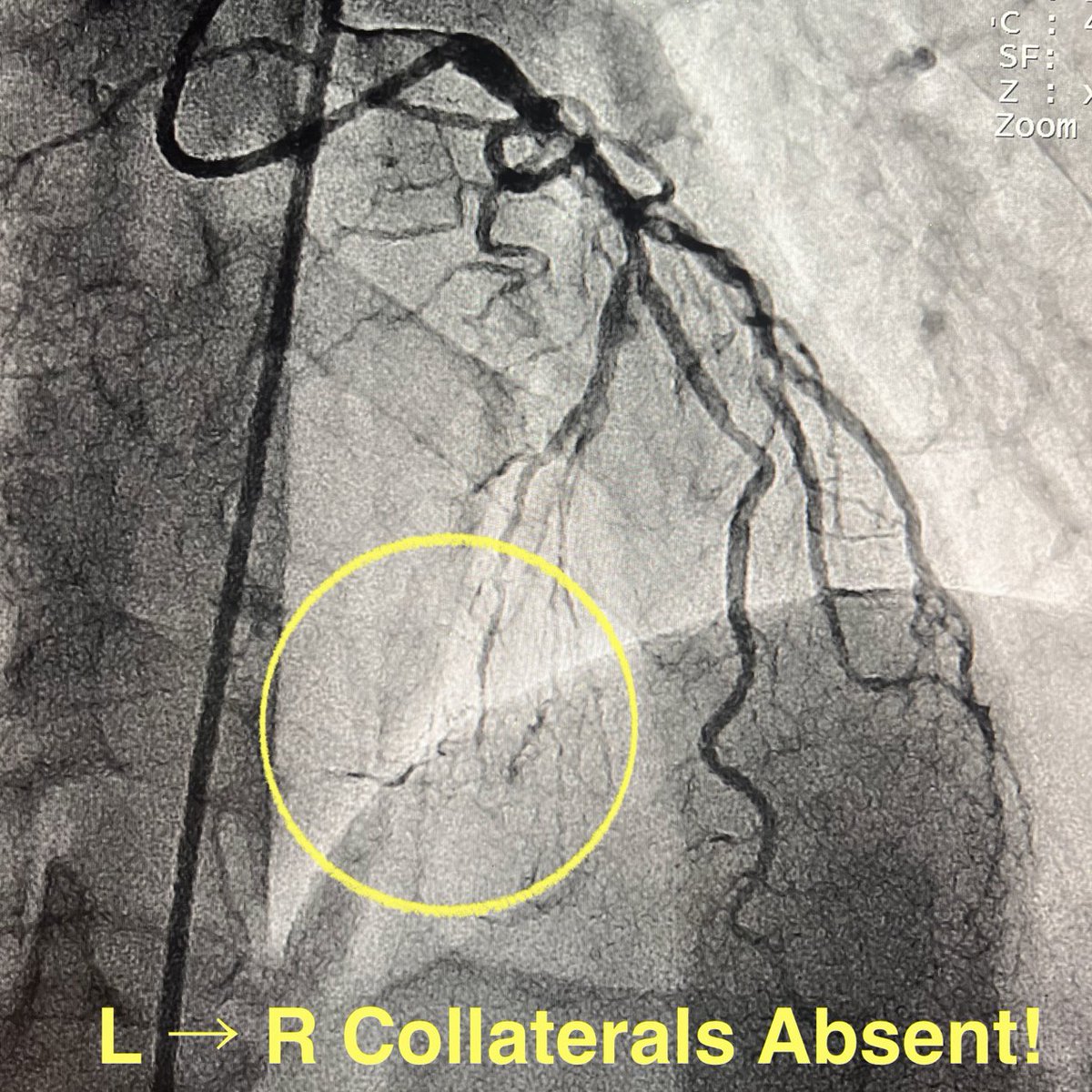 realarainmd's tweet photo. @JoySanyal74 Our #TDADR attempt got us into the RV branch but on the opposite side of the TL behind Ca. 😢

We failed RTIG CTO re-entry → so did blocking balloon assisted STAR for the PLB and CBA AFR for the PDA. 

But we restored antegrade flow! Note the ‘missing’ left 👉🏼 right collaterals! https://t.co/vk7De987s9