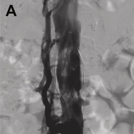 JVS - Venous and Lymphatic Disorders tweet media