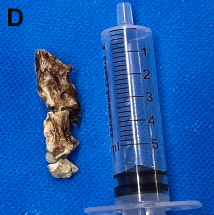 JVS - Venous and Lymphatic Disorders tweet media