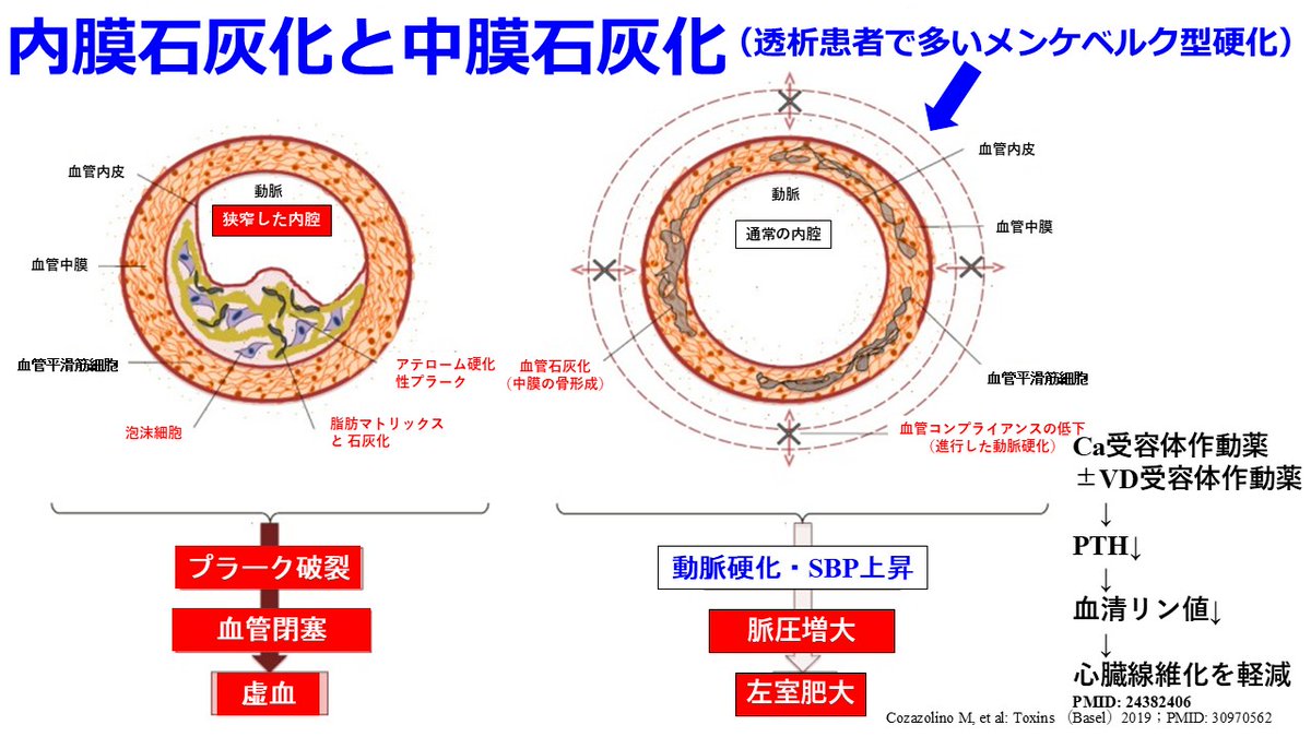 Jun_Hirosena's tweet photo. 非透析日にアダラートCRのような強力な降圧薬、透析日には降圧薬を中止してリズミックの処方はなんで？
同じ患者に降圧薬と昇圧薬が処方されたら、新人薬剤師は混乱してしまうだろうね。でも透析患者ではふつうにみられることだ。結論から言おう。透析患者の多くは血管石灰化が進行しており、脈圧の増大と強く関連しているからだ。脈圧＝収縮期血圧－拡張期血圧だけど、これは心機能の低下した後期高齢者に多いが、透析患者ではこれが若年者でも起こりやすく、心血管イベントや死亡のリスクを高める重要な要因になっている。
その原因はCKD－MBD（慢性腎臓病に伴う骨・ミネラル代謝異常）によることが多い。腎機能が低下すると、腎におけるリン排泄能が低下しリン利尿ホルモンのFGF-23の産生が亢進し、腎におけるビタミンDの活性化を障害して高リン血症・低Ca血症状態が持続する。そのためPTHの分泌が亢進して骨を溶かして血清Ca値を上げるから骨がスカスカになって線維性骨炎になり、血管では石灰化が亢進する。健常者でも内膜の石灰化は起こるが透析患者の血管石灰化は血管の中膜にヒドロキシアパタイト、つまり骨ができる（メンケベルク型の動脈硬化）。血管が骨のように硬くなるから高血圧は必発！これを防ぐにはPTHが上がらないようにリン・Caのコントロール、そしてPTHをオルケディアⓇのようなCa受容体作動薬（カルシミメティクス）と活性型ビタミンD（VD受容体作動薬）によって下げるけど、これらの治療がうまくいっていない方は動脈の弾力性が全く失われる。だから心収縮によって生じた圧を動脈が吸収しきれない（血管進展性が不良になっている）から収縮期血圧は非常に高くなるが、その結果、拡張期血圧は低くなって脈圧が増大する。透析中に体外循環・除水によって循環血漿量が減少すると血管コンプライアンスが低いので、一転して著明な低血圧になる。低血圧ショックにならないよう、昇圧薬を投与せざるを得なくなるんだ。CKD－MBDの新ガイドライン2025ではPとCa管理はPTH管理より優先し、Ca 9.5未満、P 5.5mg/dL未満と厳しくなったことも知っておこう。