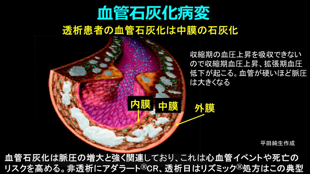 Jun_Hirosena's tweet photo. 非透析日にアダラートCRのような強力な降圧薬、透析日には降圧薬を中止してリズミックの処方はなんで？
同じ患者に降圧薬と昇圧薬が処方されたら、新人薬剤師は混乱してしまうだろうね。でも透析患者ではふつうにみられることだ。結論から言おう。透析患者の多くは血管石灰化が進行しており、脈圧の増大と強く関連しているからだ。脈圧＝収縮期血圧－拡張期血圧だけど、これは心機能の低下した後期高齢者に多いが、透析患者ではこれが若年者でも起こりやすく、心血管イベントや死亡のリスクを高める重要な要因になっている。
その原因はCKD－MBD（慢性腎臓病に伴う骨・ミネラル代謝異常）によることが多い。腎機能が低下すると、腎におけるリン排泄能が低下しリン利尿ホルモンのFGF-23の産生が亢進し、腎におけるビタミンDの活性化を障害して高リン血症・低Ca血症状態が持続する。そのためPTHの分泌が亢進して骨を溶かして血清Ca値を上げるから骨がスカスカになって線維性骨炎になり、血管では石灰化が亢進する。健常者でも内膜の石灰化は起こるが透析患者の血管石灰化は血管の中膜にヒドロキシアパタイト、つまり骨ができる（メンケベルク型の動脈硬化）。血管が骨のように硬くなるから高血圧は必発！これを防ぐにはPTHが上がらないようにリン・Caのコントロール、そしてPTHをオルケディアⓇのようなCa受容体作動薬（カルシミメティクス）と活性型ビタミンD（VD受容体作動薬）によって下げるけど、これらの治療がうまくいっていない方は動脈の弾力性が全く失われる。だから心収縮によって生じた圧を動脈が吸収しきれない（血管進展性が不良になっている）から収縮期血圧は非常に高くなるが、その結果、拡張期血圧は低くなって脈圧が増大する。透析中に体外循環・除水によって循環血漿量が減少すると血管コンプライアンスが低いので、一転して著明な低血圧になる。低血圧ショックにならないよう、昇圧薬を投与せざるを得なくなるんだ。CKD－MBDの新ガイドライン2025ではPとCa管理はPTH管理より優先し、Ca 9.5未満、P 5.5mg/dL未満と厳しくなったことも知っておこう。