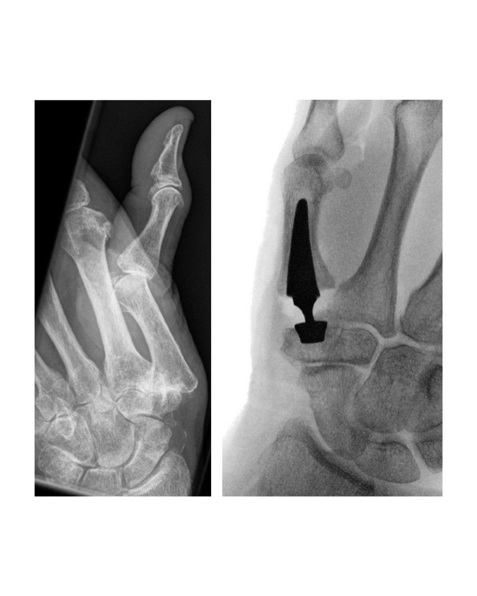 BoneJointJ's tweet image. The SCOOTT is a multicentre, three-arm, RCT which is currently being undertaken, comparing the clinical outcomes and cost-effectiveness of an enhanced package of non-surgical management, trapeziectomy, and thumb CMCJA.

#RCT #Thumb #Ortho #Surgery #Trial

ow.ly/Mio350XToqI