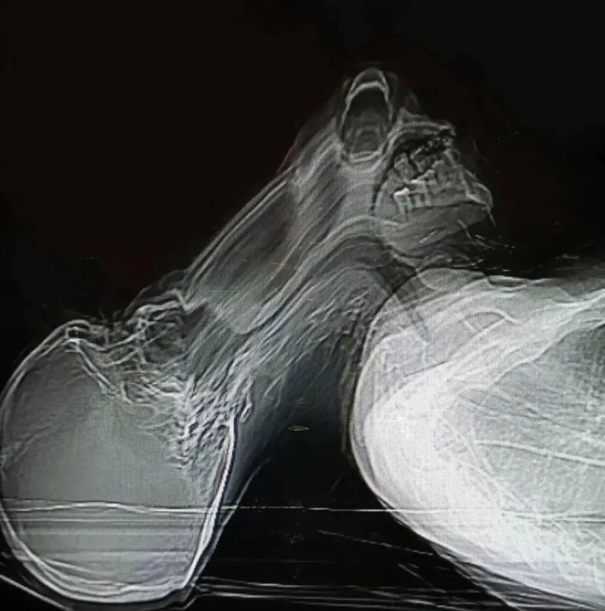 CT촬영 중 재채기한 결과