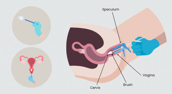 Nsengiymvathier's tweet photo. Did you know most cervical cancers are caused by HPV infection. Knowing your HPV status through testing is a powerful step toward prevention. Get a HPV screening at your nearby @RBCRwanda health facility!
#EndCervicalCancer
#HPVScreening https://t.co/Mylvyeo2Rs