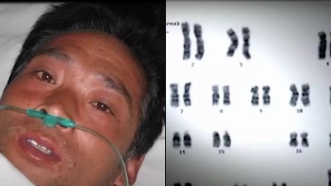MorbidKnowledge's tweet photo. On September 30, 1999, Hisashi Ouchi suffered the worst radiation exposure in history, 17 Sieverts, during a nuclear accident at a Tokaimura fuel plant.

Transported to the University of Tokyo Hospital, Ouchi was diagnosed with severely depleted white blood cells, requiring extensive skin grafts and multiple blood transfusions.

According to local reports from the time, he was described as 'crying blood' and pleaded with doctors to cease his treatment.

On the sixth day post-accident, an expert examining chromosome images from Ouchi's bone marrow cells observed scattered black dots, signifying their fragmentation. This meant Ouchi's body lacked the ability to regenerate new cells.

His condition continued to deteriorate.

Examinations revealed that radiation had eradicated the chromosomes responsible for skin regeneration, causing the gradual disappearance of his epidermis, the protective outer layer of his body.

By the two-week mark post-accident, he lost the ability to eat and required intravenous feeding. 

Two months into the ordeal, his heart ceased, but medical intervention successfully revived him.

On December 21, after 83 agonizing days, Ouchi died of multiple organ failure.