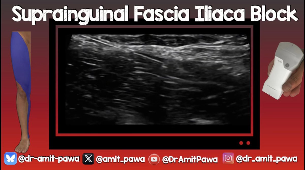 amit_pawa's tweet photo. As we approach the @Assoc_Anaes #WSM2026 I figured I’d release some of the content from my talk in advance! 

Here is an update to my #SIFI block video https://t.co/mrTZJ2YKea

Block video courtesy of @mick_kerr 🙏🏽🙏🏽

#RegionalAnaesthesia #RegionalAnesthesia https://t.co/BNgWZ2GMP9