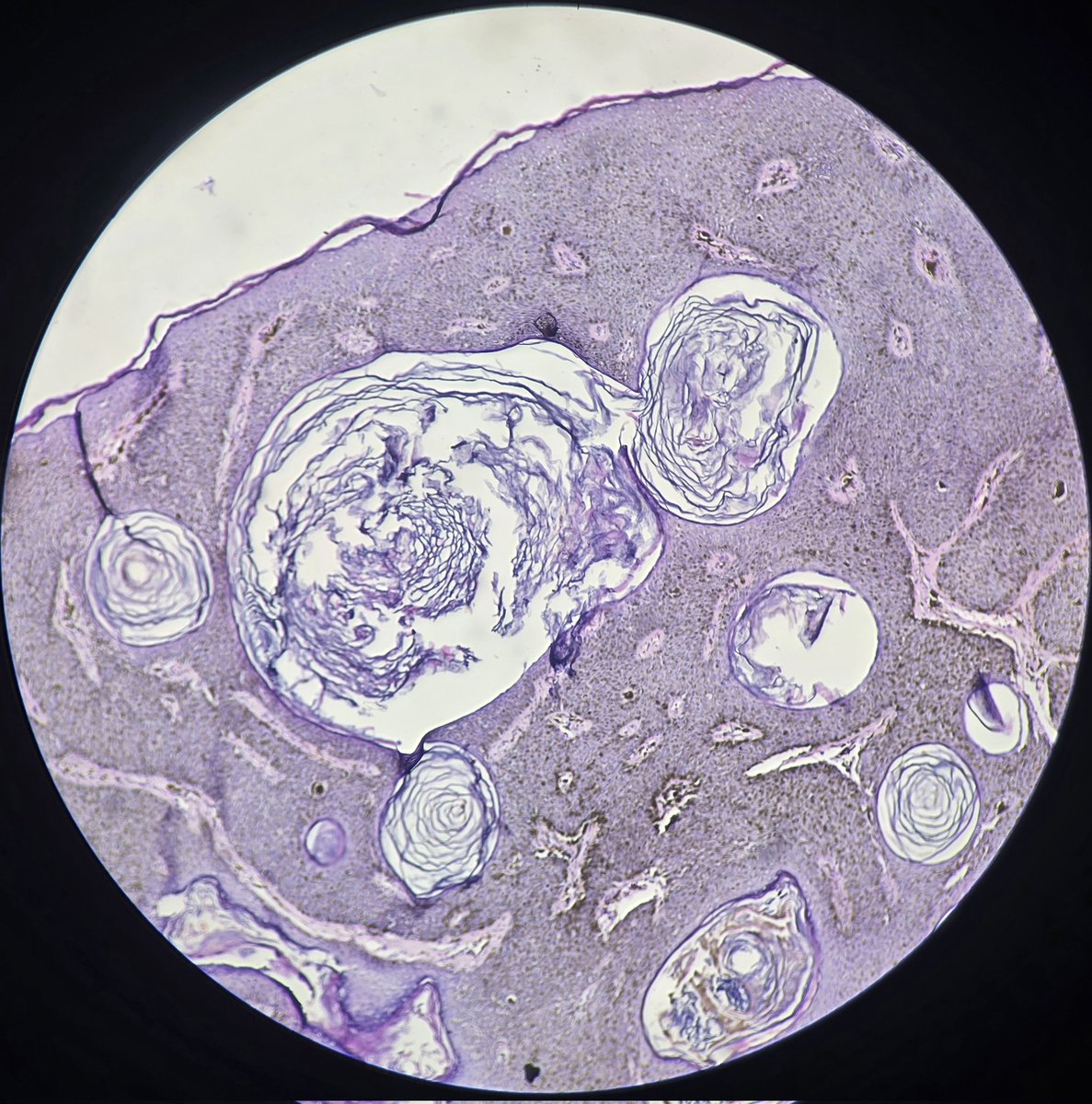pathphyo's tweet photo. A lovely pigmented seborrheic keratosis on lower eyelid as a weekend treat.
#pathology #dermpath #SK #benign https://t.co/RzFgcz0ls5