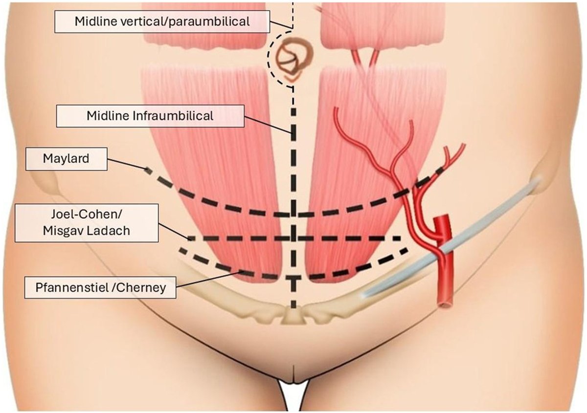 AJOG Expert Review in Cesarean: Surgical management of complex cesarean delivery https://ow.ly/eqYT50XUB1Q 