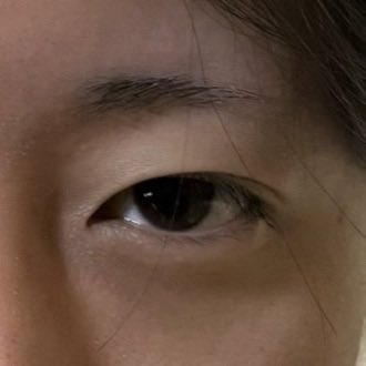 173canta's tweet photo. 日本で受けた埋没二重が取れかかってたから韓国のAB美容外科で手直ししてもらったんだけど、施術後は目の開きが良くなった気がする
ただの切開二重と違って、目つき矯正もしてくれるからお得だよね
カウンセリングも丁寧だし通訳も親切で大満足です💯

＃整形内容 ＠ABPRS_JP https://t.co/0v1imTz6UV