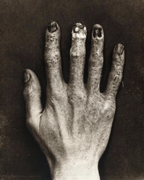 gkduda's tweet photo. @holisticgrenade This is the hand of an x-ray tech from London in 1900.  This is what happens when you get constant exposure to x-rays.  1 x-ray is safe.  35 a day for a year is not. https://t.co/CCShblIPAU