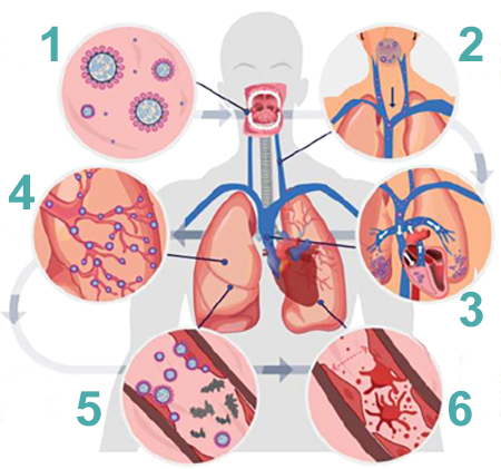 DrGrahamLJ's tweet image. 5 years to the day since formal peer-reviewed publication of the original hypothesis proposing passage of #SARS2 to the lungs from the mouth via the bloodstream, linking poor oral health (gum disease) with severity of #COVID-19 lung disease.
👇👇👇
genesispub.org/j-oral-med-and…