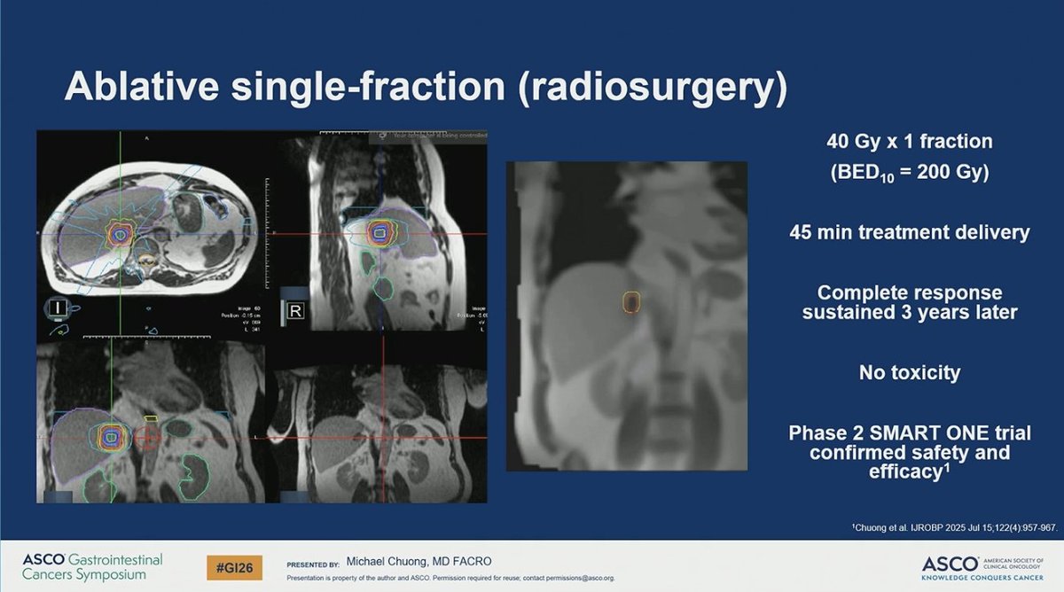 NiuSanford's tweet image. Great presentation on advancements in RT for liver metastases.

Ablative RT can be curative, non-invasive, &amp;amp; efficient.

No better person than @MikeChuongMD to highlight the evolution &amp;amp; potential of innovative RT technologies in this space. #GI26