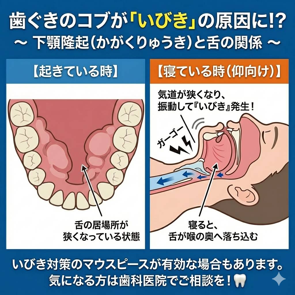 yukichi_ibiki's tweet image. 食いしばりの証拠のこのコブ。
実はもう一つ重要な問題が…
​下の歯の内側にある【下顎隆起（かがくりゅうき）】は、なんと「いびき」の原因にもなり得ます！😱

​骨のコブで口の中が狭くなり、寝ている間に舌が喉の奥へ追いやられて気道を塞いでしまうからです💤…