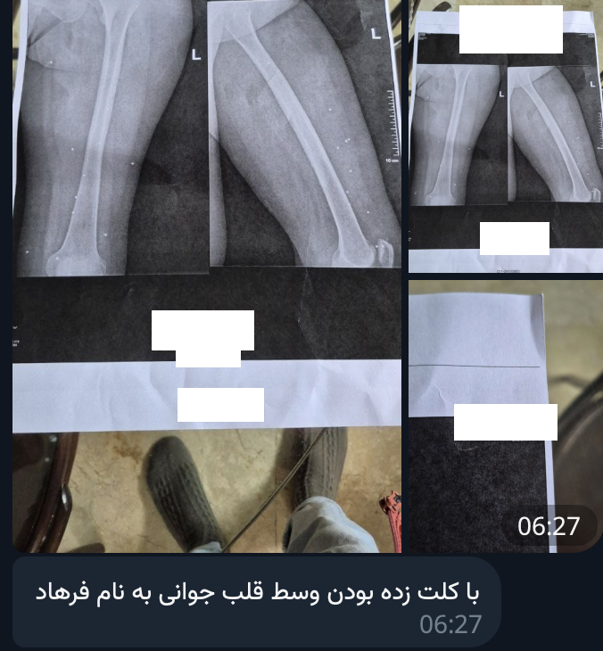 mamlekate's tweet photo. «جمعه ۱۹ دی ۱۴۰۴ تیر رو بستن رو همه تو تهرانپارس ، از ساعت ۸ شب به بعد ، من خواهرم پاهاش تیر خورده ، و تو اون یک ساعت که اونجا بودیم در بیمارستان نیکان حکیمیه کم کم ۵ جوون مردن. با کلت زده بودن وسط قلب جوانی به نام فرهاد. بیمارستان تمام دکتر هاشو اورده بود. بیمارستان نهایت همکاری و مهربانی رو انجام داد.»