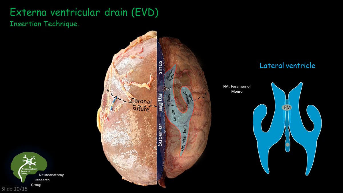 NeuroanatomyRG's tweet photo. Precision matters.... ➪🧠
External Ventricular Drain (𝗘𝗩𝗗) insertion is all about surface landmarks: 
- 𝗘ntery point.
- 𝗧rajectory.
- 𝗩𝗲𝗻𝘁𝗿𝗶𝗰𝘂𝗹𝗮𝗿 - Target.

𝗥especting ventricular anatomy—small angles, big consequences. https://t.co/5otdcNTVaD