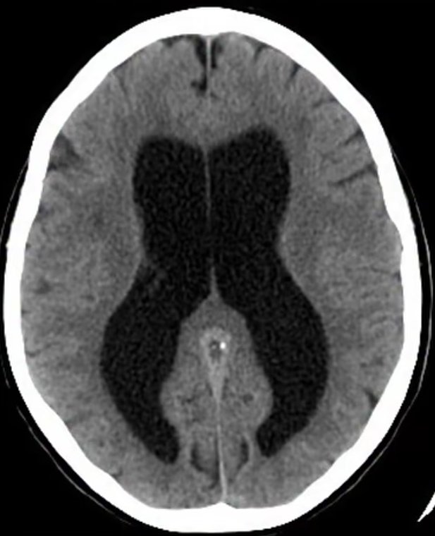nervemed's tweet photo. What is the most likely diagnosis❓

A. Cerebral Atrophy
B. Hydrocephalus
C. Subdural Hematoma
D. Pseudotumor Cerebri https://t.co/5FlXoF6KCp
