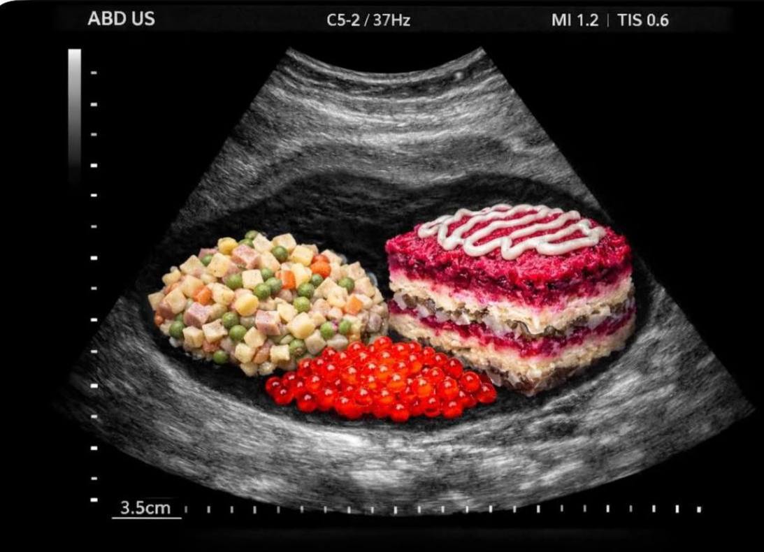 Был сегодня на УЗИ , пора завязывать с вкусняшками.