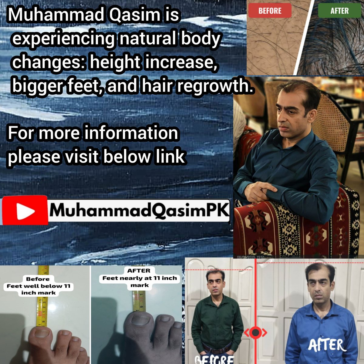 Hair growing again reflects the sign from God. Muhammad Qasim. 
<a href="/RTErdogan/">Recep Tayyip Erdoğan</a> <a href="/CMShehbaz/">Shehbaz Sharif</a> <a href="/ForeignOfficePk/">Ministry of Foreign Affairs - Pakistan</a> <a href="/GovtofPakistan/">Government of Pakistan</a> <a href="/prabowo/">Prabowo Subianto</a>