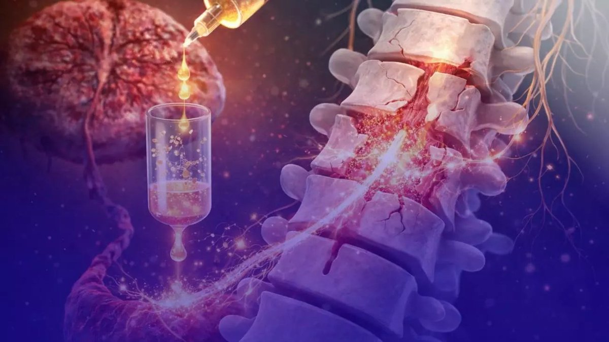 astronomiaum's tweet image. 🚨URGENTE: Proteína da placenta ajuda brasileiros a recuperar movimentos após lesão medular. Subiu para quatro o número de pacientes tetraplégicos ou paraplégicos que retomaram os movimentos após a administração do medicamento experimental brasileiro polilaminina. Viva a ciência…